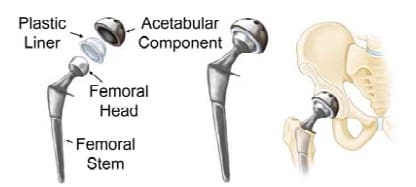 Figure 1- The images from left to right show the individual components of a total hip implant